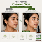 Salicylic Acid Face Serum for Blackheads & Clear Skin